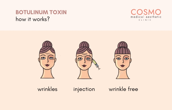 HOW DOES BOTOX WORK