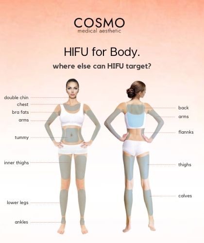 can hifu cause fat loss - hifu body