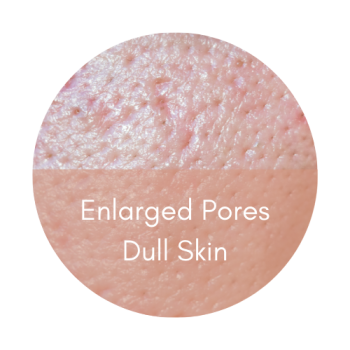 enlarged pores