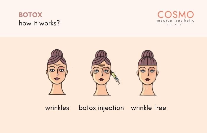 how does botox injection works?