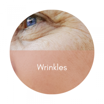 profhilo for wrinkles