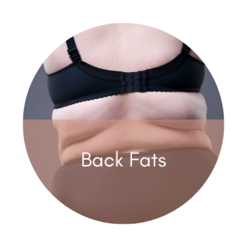 fat freezing back fats
