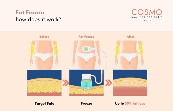 how does fat freezing work