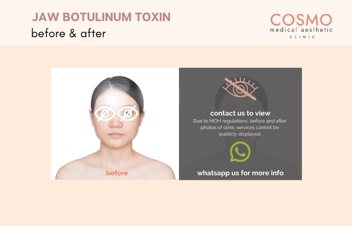 JAW BOTOX BEFORE AND AFTER