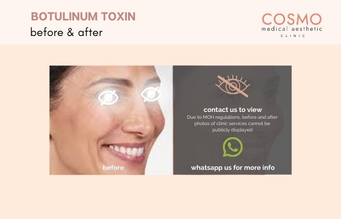 WRINKLES BOTOX BEFORE AND AFTER