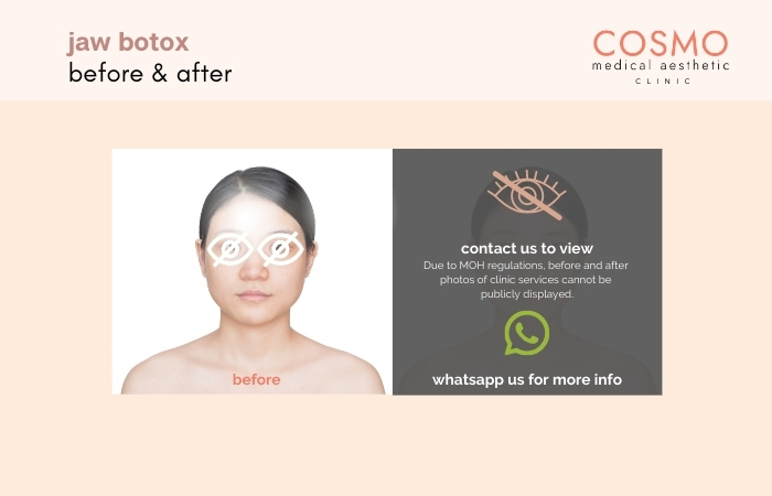 jaw botox before and after